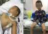 Bác sĩ chia sẻ hành trình giành lại sự sống cho bé trai 5 tuổi té ngã gần đứt lìa cổ họng