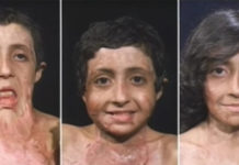 Con gái 9 tuổi bị bỏng đến tan chảy khuôn mặt, cha cầu cứu suốt 4 năm và phép màu đã đến