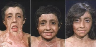 Con gái 9 tuổi bị bỏng đến tan chảy khuôn mặt, cha cầu cứu suốt 4 năm và phép màu đã đến