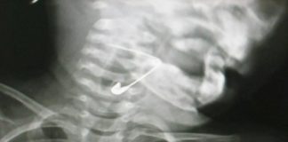 Điểm tin mới ngày 25/8: Siêu âm X-quang, bác sĩ hết hồn thấy kim băng xiên ngang thực quản bé gái 18 tháng tuổi
