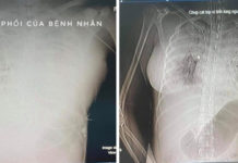 Vụ nghi án cô gái 30 tuổi t.ử v.ong sau khi nâng ngực: Vì sao bác sĩ chi 20 triệu nhờ trại hòm kh.âm l.i.ệm?