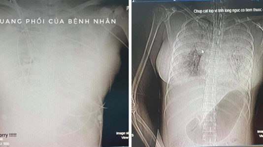 Vụ nghi án cô gái 30 tuổi t.ử v.ong sau khi nâng ngực: Vì sao bác sĩ chi 20 triệu nhờ trại hòm kh.âm l.i.ệm?