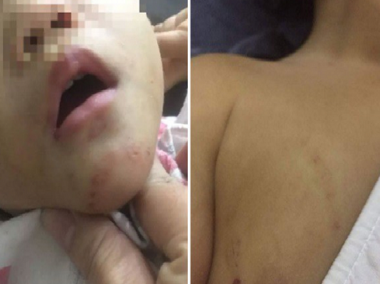 Hải Phòng: Bé gái 16 tháng tuổi nghi bị bạo hành với nhiều vết thương trên cơ thể, công an vào cuộc xác minh