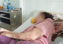 Cán bộ QLTT đ.ánh bạn gái dập mũi, vỡ hàm, chảy máu mắt vì hát song ca với người khác