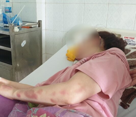 Cán bộ QLTT đ.ánh bạn gái dập mũi, vỡ hàm, chảy máu mắt vì hát song ca với người khác